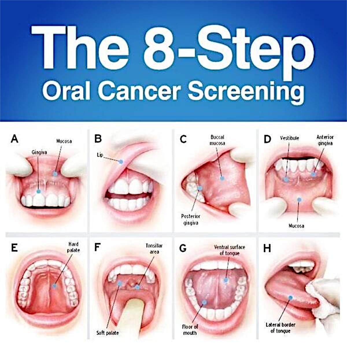 Oral cancer awareness poster
