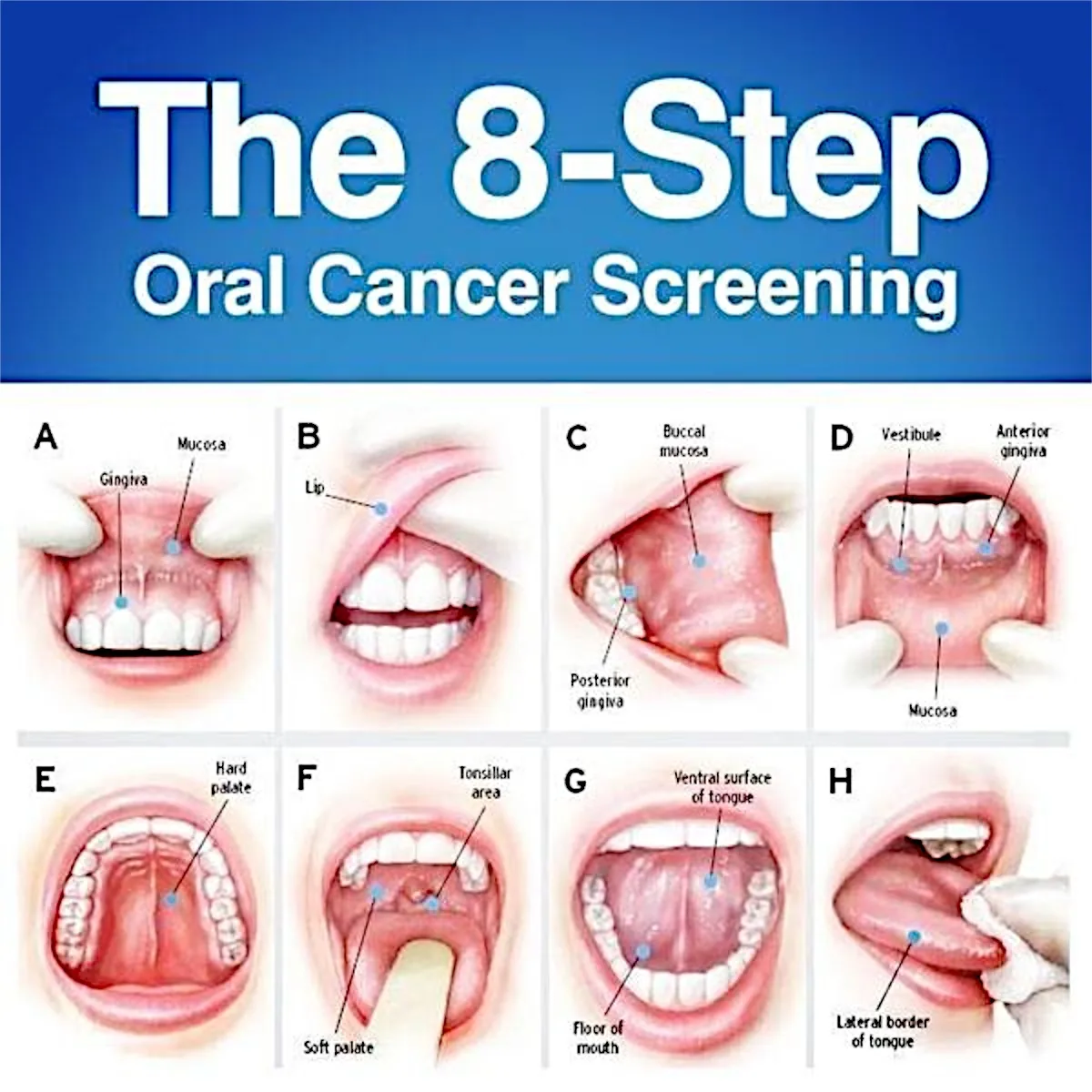 Oral cancer awareness poster